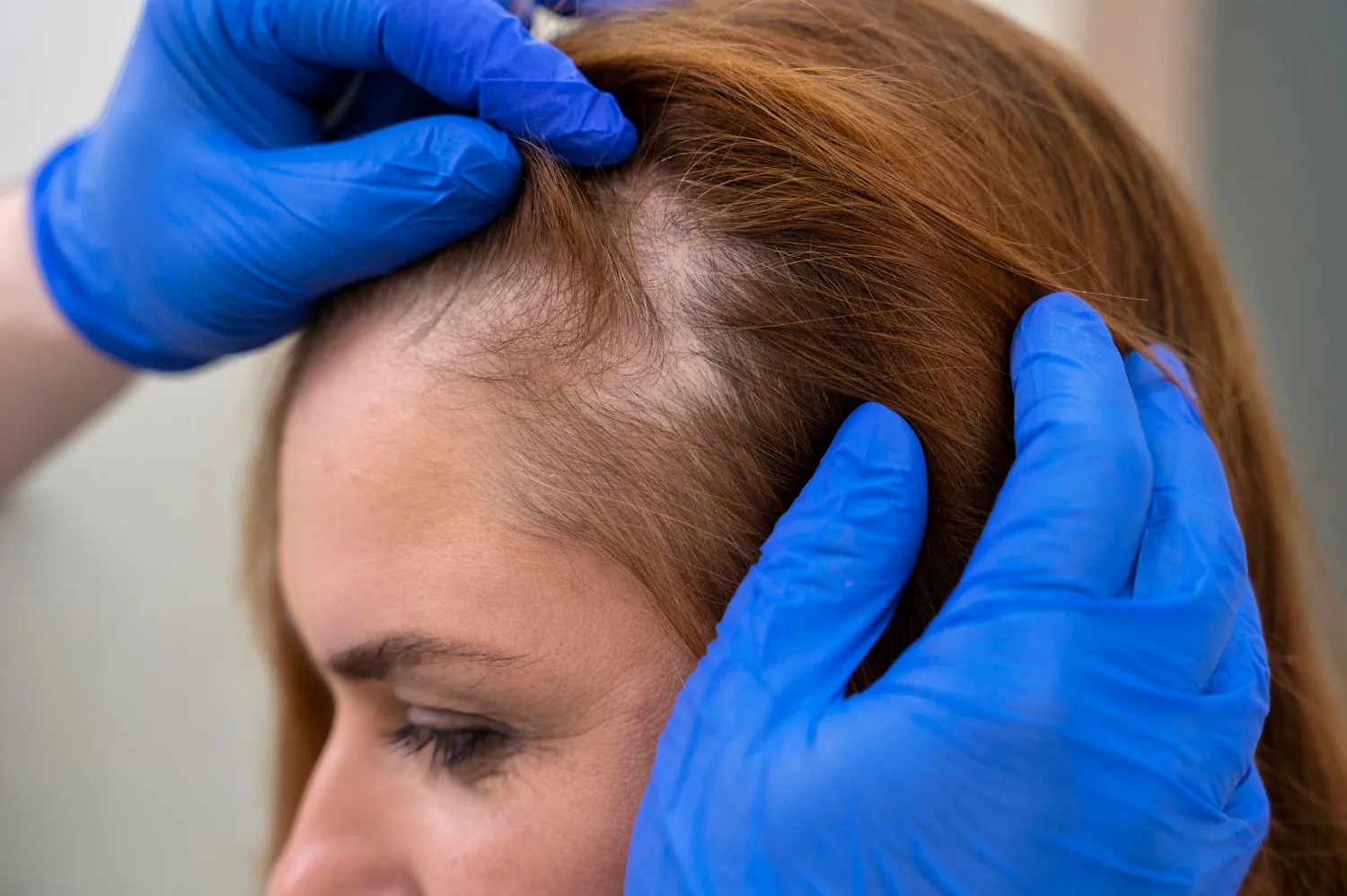 Alopecia y Caída del Cabello en Naucalpan y Tlalnepantla: Diagnóstico y Tratamiento Avanzado