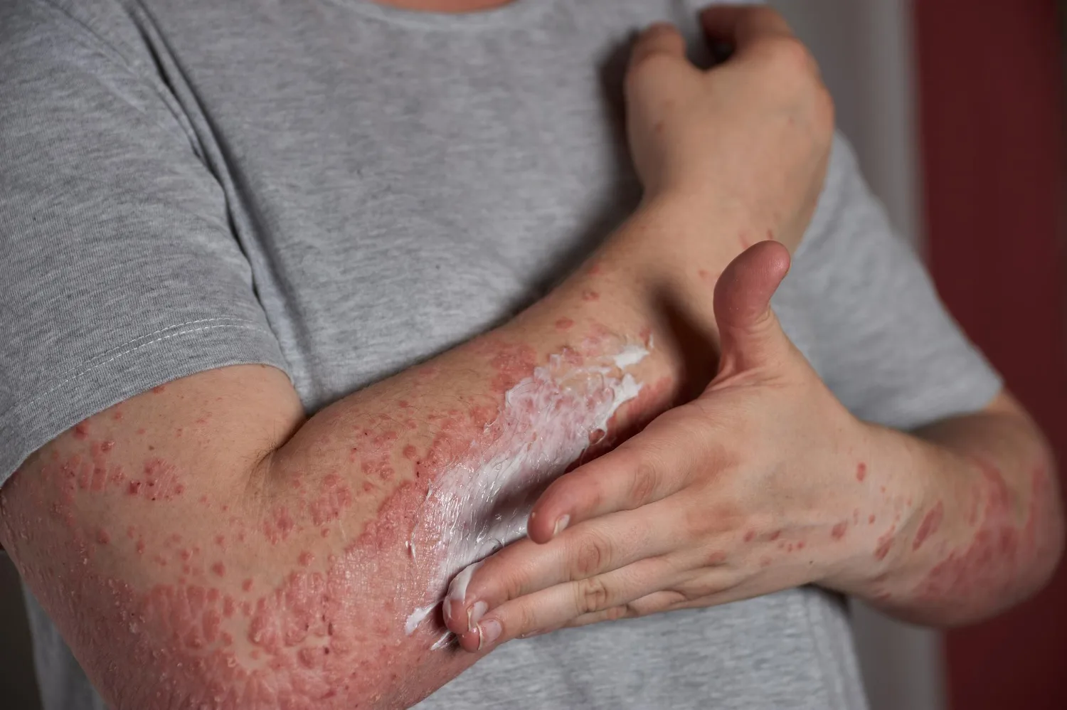 Dermatitis Atópica en Naucalpan y Tlalnepantla: Tratamiento Especializado con el Dr. Salvador Alonso Gutiérrez Ávila