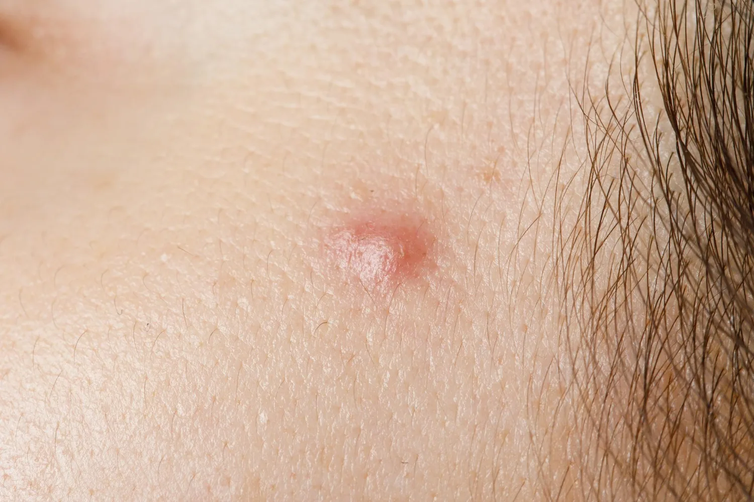 Hidradenitis Supurativa en Naucalpan y Tlalnepantla: Tratamiento Especializado con el Dr. Salvador Alonso Gutiérrez Ávila